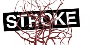 Lakukan 5 Hal Ini dapat Mengurangi Resiko Stroke di Usia Muda