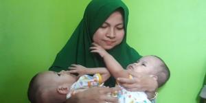 Dana Rp1 Miliar Terkumpul, Bayi Kembar Siam di Tangerang Segera Operasi