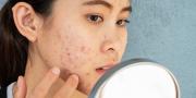 Simak 5 Tips Atasi Jerawat Tanpa Skincare